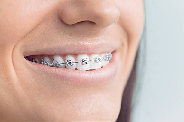 Best Traditional Braces  in Orrville, OH